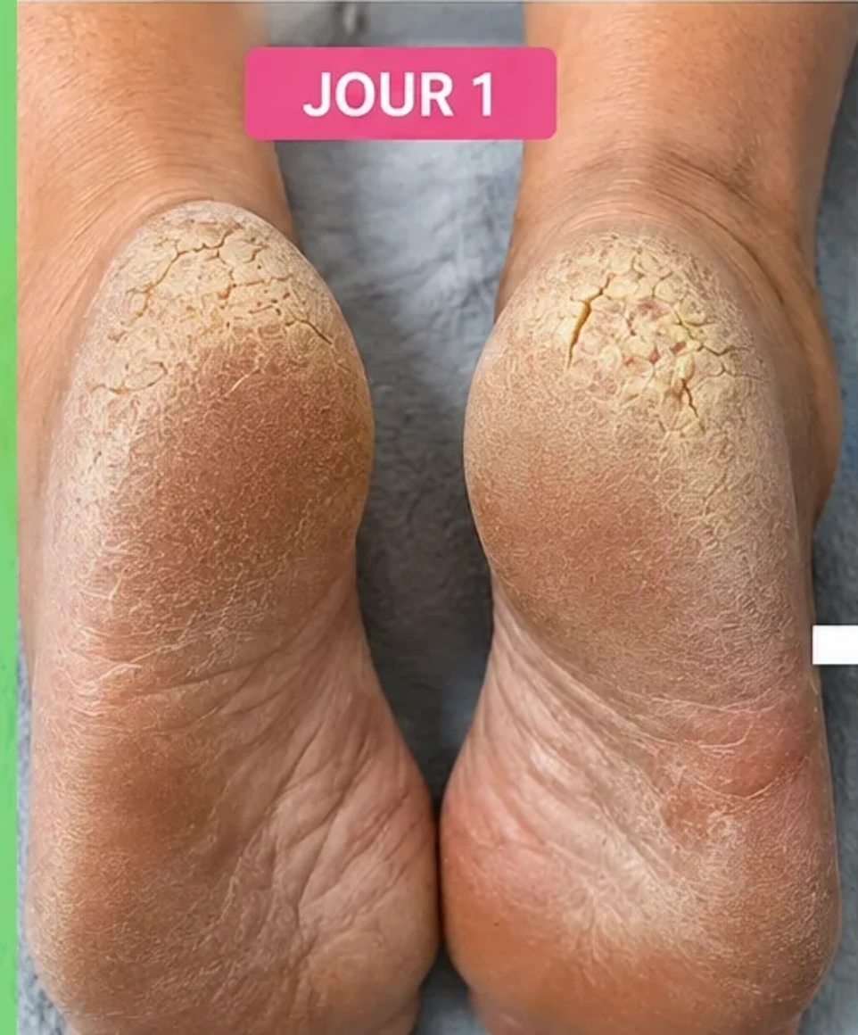 Pieds abîmé callosités+secs-fussures